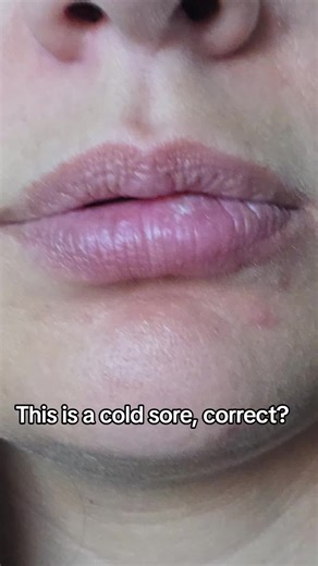 Ive gotten this a handful of times over the last 7yrs always in this spot, but im not 100% sure if its a cold sore bc its on the inner side, only hurt a couple times ive had it but not like what I read of cold sores.. #coldsores