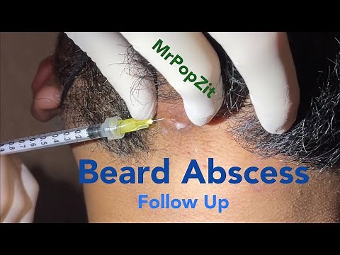 Beard abscess follow up. Doing great. Kenalog injection for some leftover inflammation. MrPopZit
