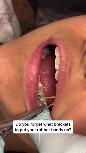 Remembering Braces Rubber Bands: Easy Tips from #DOGorthodontics