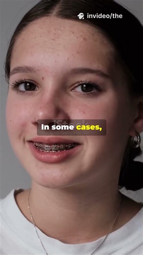 Will Braces Change Your Face Shape? #bracestreatment #braces #bracestips #orthodontist #dentaltips