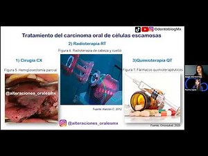 Oral Squamous Cell Carcinoma