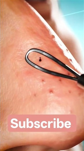 How to Actually Get Rid of Blackheads Forever 😮 #shorts #skincare