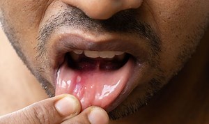 Bupa UK explains the common causes of mouth ulcers