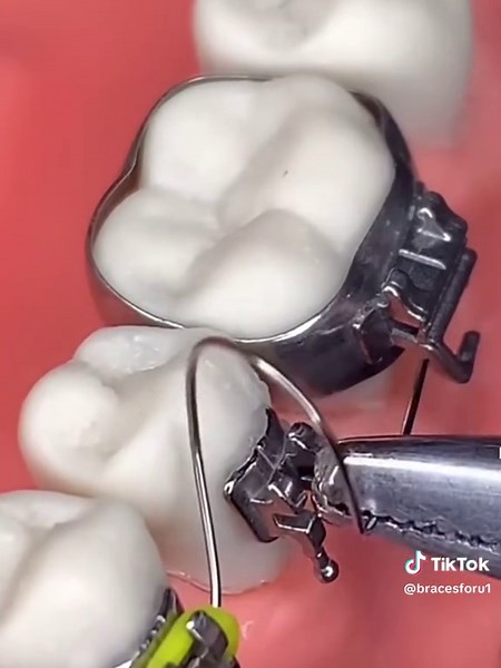 Understanding Spacers in Orthodontics