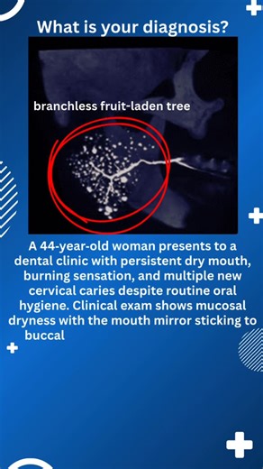 Dental Symphony on Instagram: "Primary Sjögren’s syndrome (SS): •⁠ ⁠SS is a chronic autoimmune exocrinopathy with lymphocytic destruction of salivary and lacrimal glands, producing sicca symptoms (xerostomia and dry eyes). •⁠ ⁠It most commonly affects middle‑aged women and may be diagnostically delayed because dryness has many mimics. •⁠ ⁠High caries risk pattern: cervical/root caries and rapidly progressive decay can be a clue in hyposalivation. •⁠ ⁠Chairside dryness signs: mirror sticking, abs