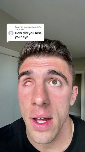 Replying to @james edwards how i lost my eye..