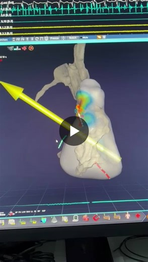 #electrophysiology #cardiacablation #roboticablation #zerofluoroscopy #epeeps #innovationinep | Laura Vitali Serdoz