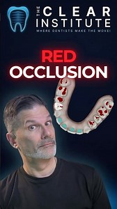How The Clear Aligner Software Deals With The Red Occlusion