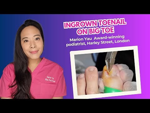 Ingrown Toenail on Big Toe? Treatment by Miss Foot Fixer Marion Yau London Uk