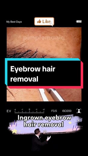 Effective Ways to Remove Ingrown Eyebrow Hair