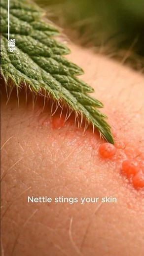 How Nettle Plants Sting the Skin