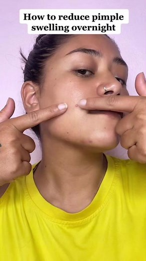 Effective Ways to Reduce Pimple Swelling Overnight