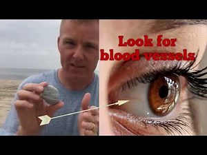 How to Observe and Name Nystagmus Eye Movements