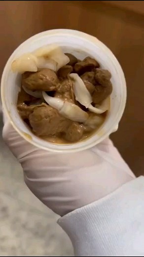 mICROBIO | Microbiología y Laboratorio Clínico on Instagram: "🚨Taenia spp. en muestra de heces 💩 ✅La teniasis en humanos es una infección parasitaria causada por la especie de tenia Taenia saginata (tenia de res), Taenia solium (tenia de cerdo) y Taenia asiatica (tenia asiática). ✅Los humanos pueden infectarse con estas tenias al comer carne de res cruda o poco cocida (Taenia saginata) o cerdo (Taenia solium y Taenia asiatica). Las personas con teniasis suelen tener síntomas gastrointestinales