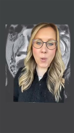 28K views · 269 reactions | an abdominal ectopic pregnancy 勞 #ectopicpregnancy #abdominalpregnancy #obgyn | Paging Dr. Fran | Facebook