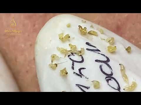 Loan Nguyen Acne Treatment #359