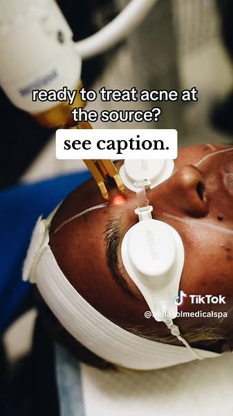 ⚡️Now available at Bella Sol Medical Spa, the most advanced treatment for acne with NeoClear by Aerolase. ⚡️NeoClear by Aerolase is a new method for clearing acne using 650 Microsecond Technology. Powerful energy is delivered in the skin to: ⚡️Reduce inflammation and swelling ⚡️Destroy acne causing bacteria ⚡️Reduce oil output All to clear existing breakouts and reduce future ones! ⚡️NeoClear is a no downtime, no side effect treatment. It is highly comfortable and safe for patients of any age or