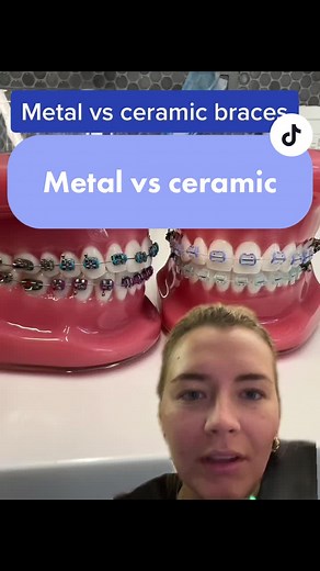 Differences Between Metal and Ceramic Braces