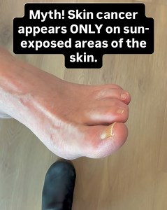 Skin cancer can show up where you least expect it. In this video, a 65-year-old professional was diagnosed with melanoma in between the toes—a spot he didn’t even know to check. He assumed skin cancer only appears on sun-exposed areas. But melanoma (and other skin cancers) can appear anywhere on the body, including places that rarely see the sun: 🦶 Between the toes 👣 Soles of the feet 🖐️ Palms and under nails 👂 Behind the ears 🧑‍🦲 Scalp 🩲 Groin/buttocks Take 60 seconds to do a head-to-toe