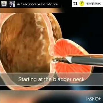 Cirugía prostática-Reseccion transuretral de Próstata-Urologo Dr Fernando Hernández.
