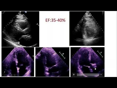 visual estimating LV Ejection Fraction