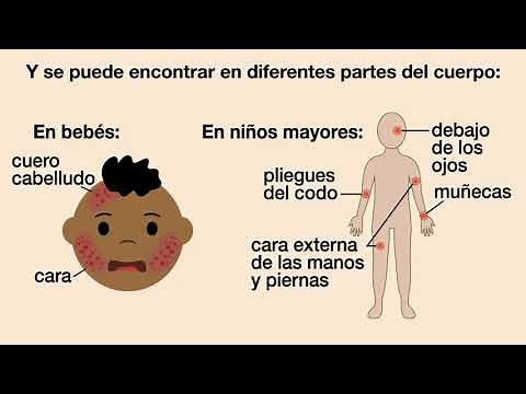 ¿Mi niño tiene eccema? | American Academy of Pediatrics (AAP)