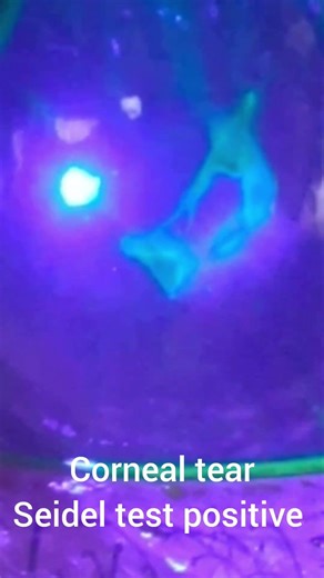 corneal tear, Seidel test