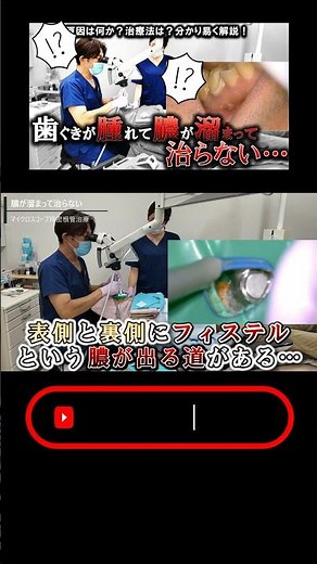 膿が溜まって治らない… #再根管治療 #宮崎歯科医院 #フィステル #膿