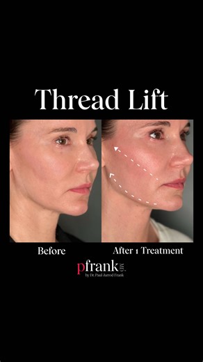 One Week After Thread Lift: Before and After Results Check out this amazing transformation after just one week post-thread lift! This patient wanted to minimize certain features and achieve a subtle lift, and we achieved just that with zero bruising and minimal swelling. She was back to her daily routine the very next day. • Bespoke Aesthetic Healthcare • PFRANKMD| The Most Cutting-Edge Technologies| Customized Signature Treatments| Only Licensed Healthcare Professionals • WARNING: Injectable co