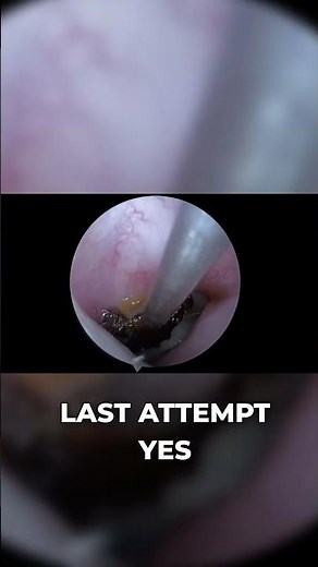 Tricky Earwax Removal: Switching to a Thin Suction Tip Solved It | Wax Short Off Episode 81