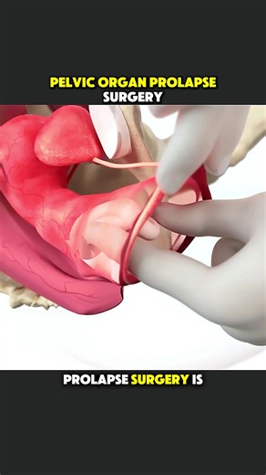Understanding Pelvic Organ Prolapse Surgery