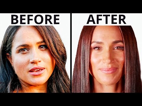 Meghan Markle's Royal Transformation | Plastic Surgery Analysis