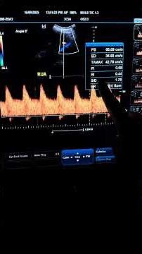 Doppler ultrasound showing the flow of life within. #pregnancy #ultrasound #doppler