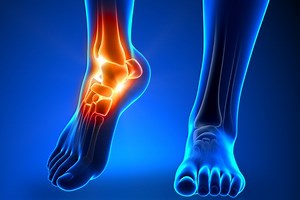 Calcaneal fractures: what they are, how to intervene