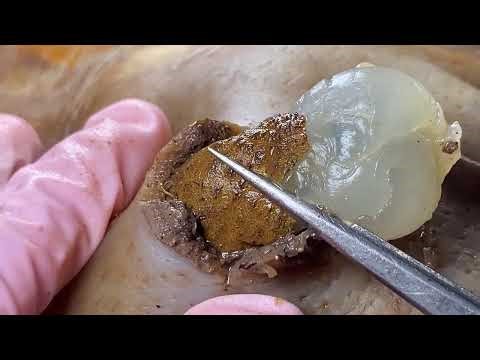 [ASMR] New #采耳哥 | Booger swax removal | Booger clean |Giant Boogerswax #Satisfying 2708M3 0268