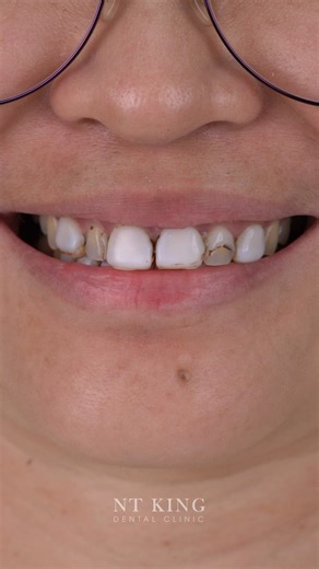 33K views · 74 reactions | ⚡️PORCELAIN VENEER ⚡️FULL PACKAGE OF 8-16...