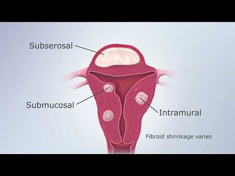 Acessa Laparoscopic Radiofrequency Ablation (Lap-RFA)