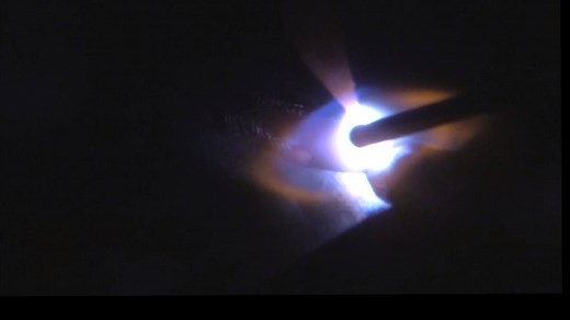 The Backstep technique for tig welding is a way to limit distortion on thin sheet metal. Backstepping is when the direction of travel is in one direction but the overall progression is in the opposite direction. All that said, its a great technique for thin sheet metal for limiting distortion. | Welding Tips & Tricks