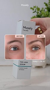 Real patients, real results. Grow thicker, fuller *natural* lashes with The Lash Serum! 👁️ Formulated by dermatologists with latanoprost that works by extending the anagen phase of lash growth to restore and revitalize your natural lashes. Get started with prescription treatments 100% online at Musely.com! | Musely