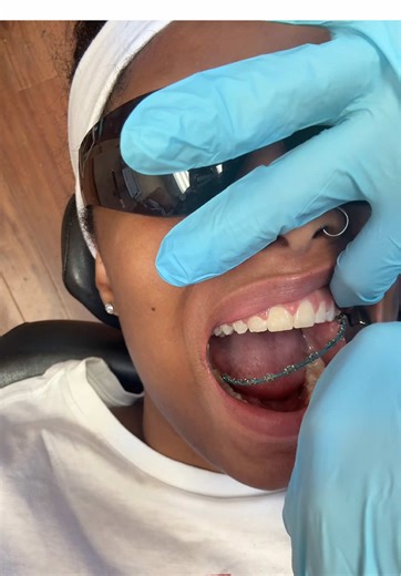 would never recommend braces unless you wanna keep paying thousands everytime you stop or fg to wear retainers honestly #fyp #braces #dental #advice #relatable