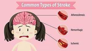 Types of stroke in the human brain