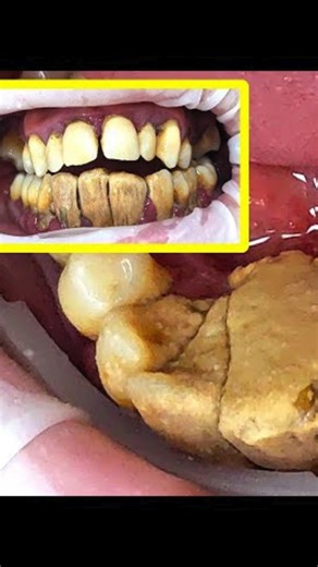 ViralGadgets Studio on Instagram: "Link in bio 🔗 the safe, at-home tool for easy dental calculus removal. `#DentalCalculusRemoval` `#TartarRemoval` `#OralHygiene` `#DentalCare` `#HomeCare` `#AmazonFinds` `#TikTokMadeMeBuyIt` `#FYP` `"