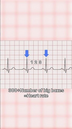 How to calculate heart rate on EKG!