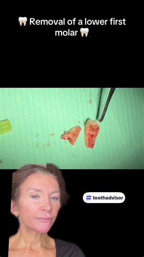 “Quick, clean, and effective 👩‍⚕️🦷 The lower molar was grossly decayed, but with bullhorn extraction forceps it was removed in under a minute. Precision matters — and so does gentle care. 💙” #extraction #toothextraction #traceybell #drtraceybell #extractionofteeth