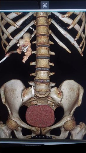 CtNephrostogram#urology#ctscan#urologist#radiology#nephrology