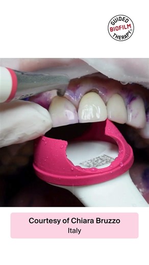 #Shorts - GBT treatment video on veneers featuring Chiara Bruzzo from Italy