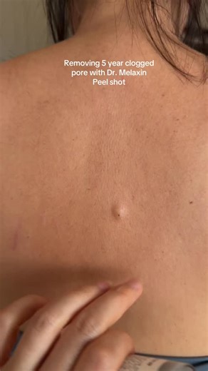 Velvelle | ‼️🔗LINK IN BIO🔗‼️ Product Name (Peel Shot Glow Set)…. It actually flattened and got most of the gunk out of that clog pore!! I was really... | Instagram