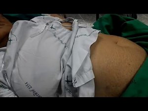 paradoxical abdominal movement