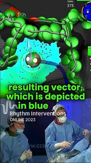 Affera Mapping and Ablation System with Sphere-9 Catheter