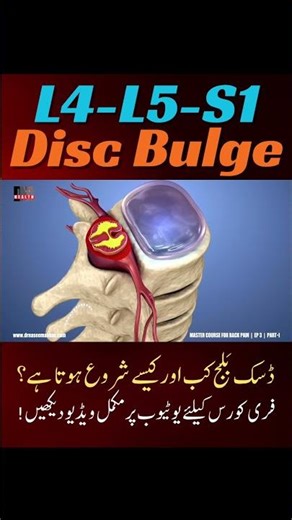 How DISC BULGE start? #discbulge #backpain #spinehealth #drnaseemabbas